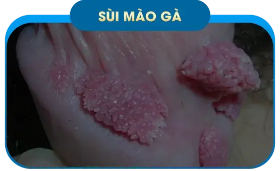 Sùi mào gà