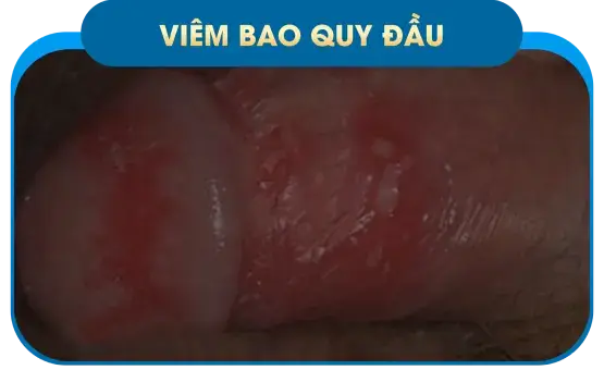 Rối loạn cương dương
