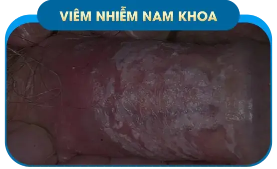 Bệnh tinh hoàn
